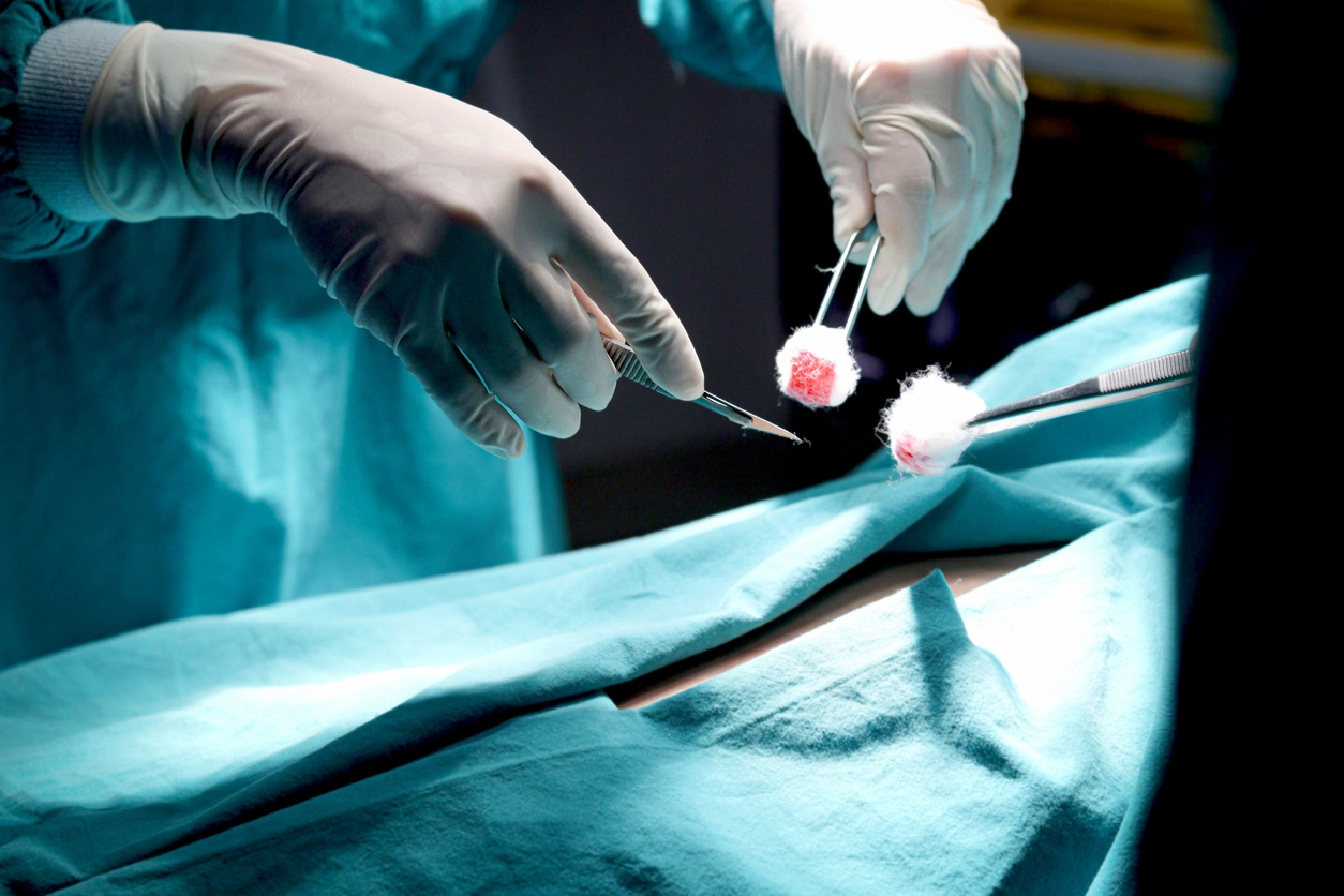 How long pilonidal cyst surgery is performed