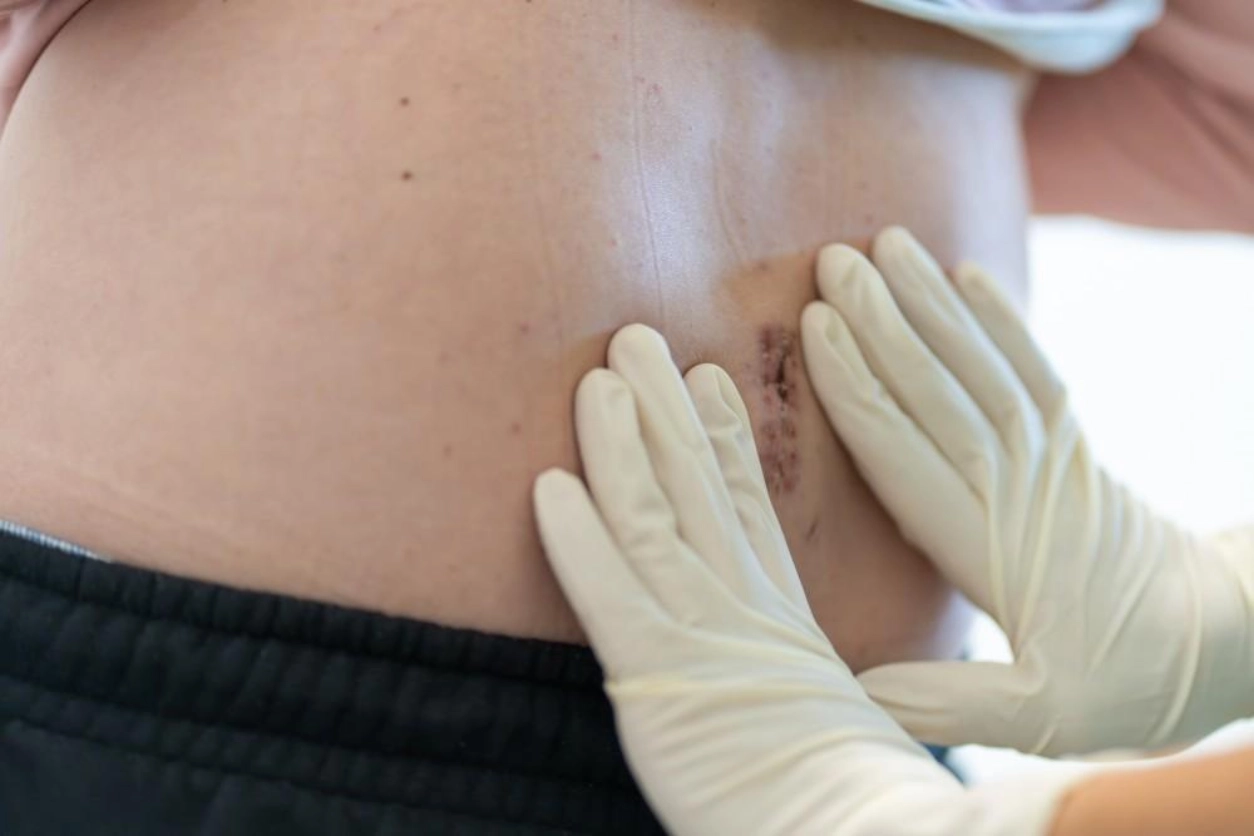 How Long Does It Take For a Pilonidal Cyst to Go Away
