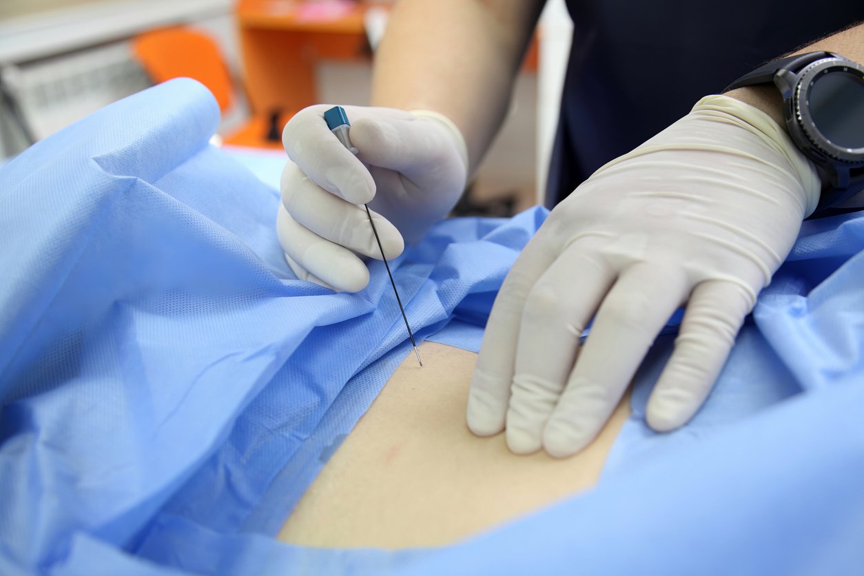Pilonidal Cysts Diagnosed