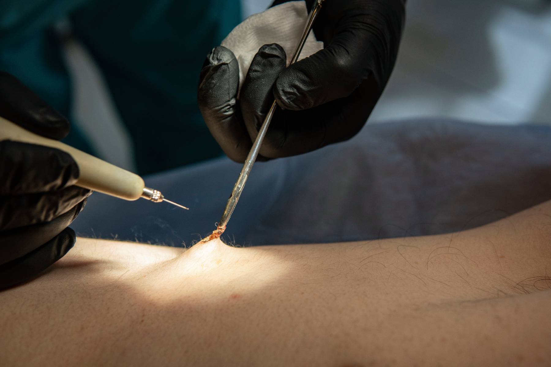 Pilonidal Cyst Treatment