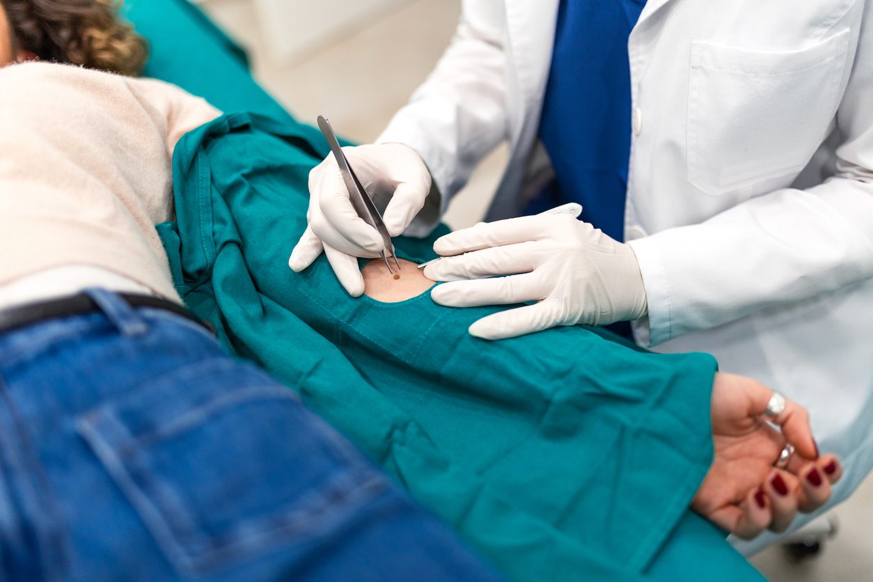 treatment-pilonidal-cysts Treatment for Pilonidal Cysts