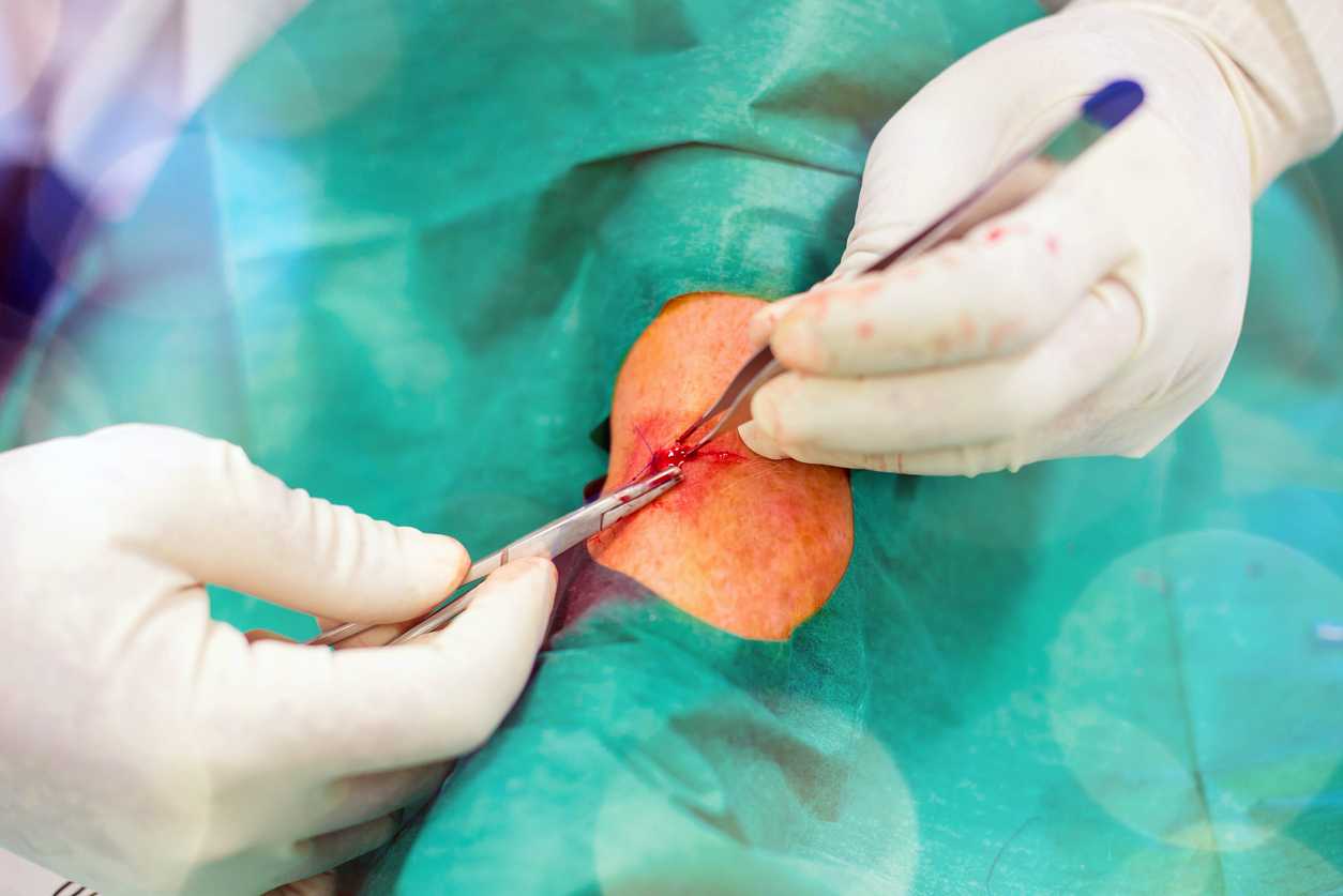 Pilonidal cyst illustration