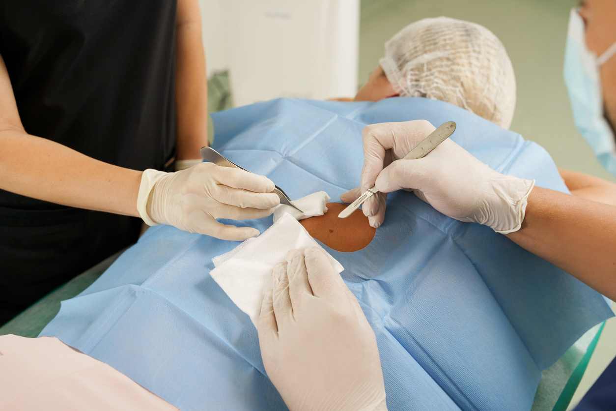 pilonidal cyst recovery pilonidal cyst recovery