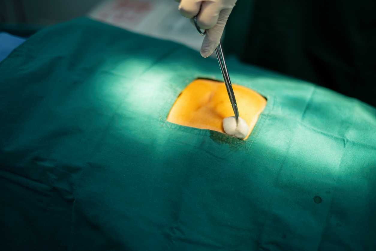 Pilonidal cyst surgery Surgical Management of Repeated Pilonidal Disease