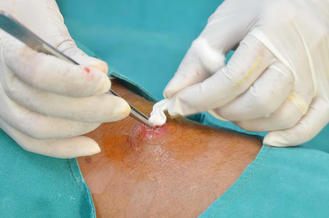 pilonidal cyst healing process