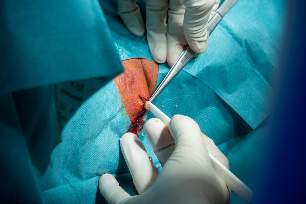 during-surgery Surgical Management of Repeated Pilonidal Disease