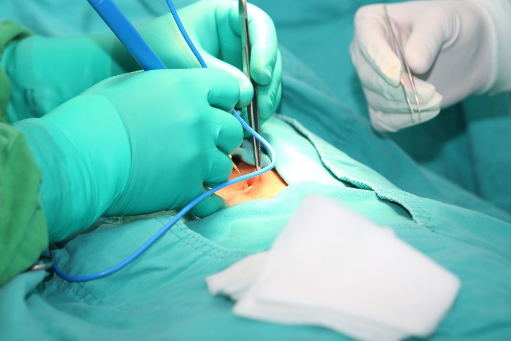 Pilonidal Cyst Operations