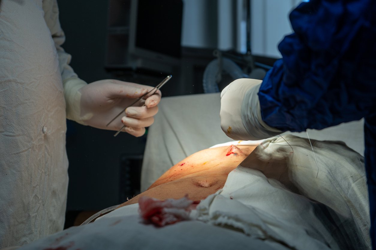 pain-and-discomfort Surgical Management of Repeated Pilonidal Disease
