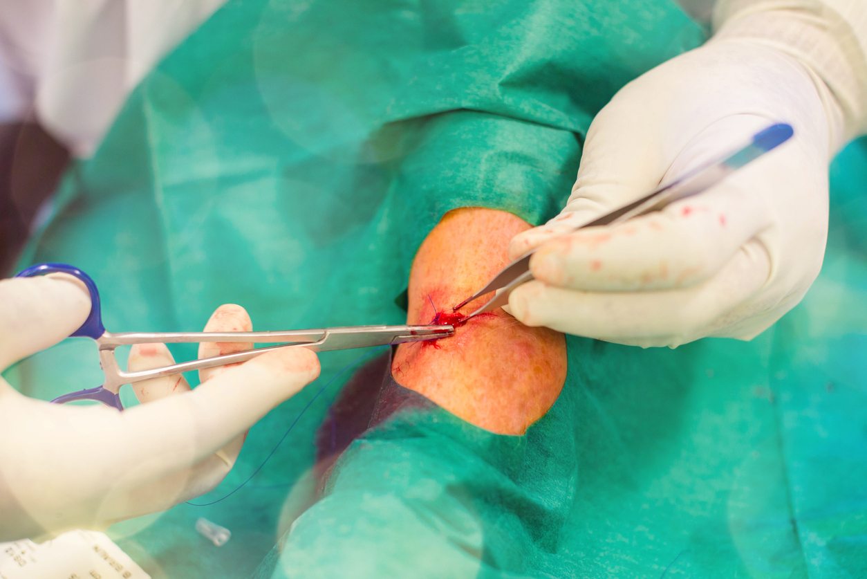 Pilonidal Surgery
