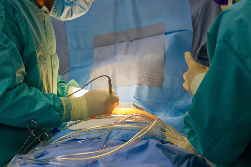 Return to Work Pilonidal Surgery