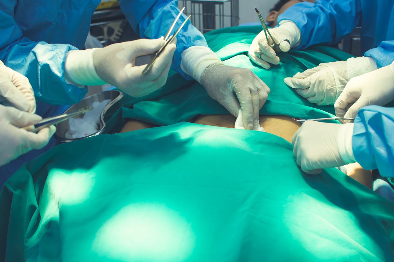 drainage normal after Pilonidal Surgical Management of Repeated Pilonidal Disease