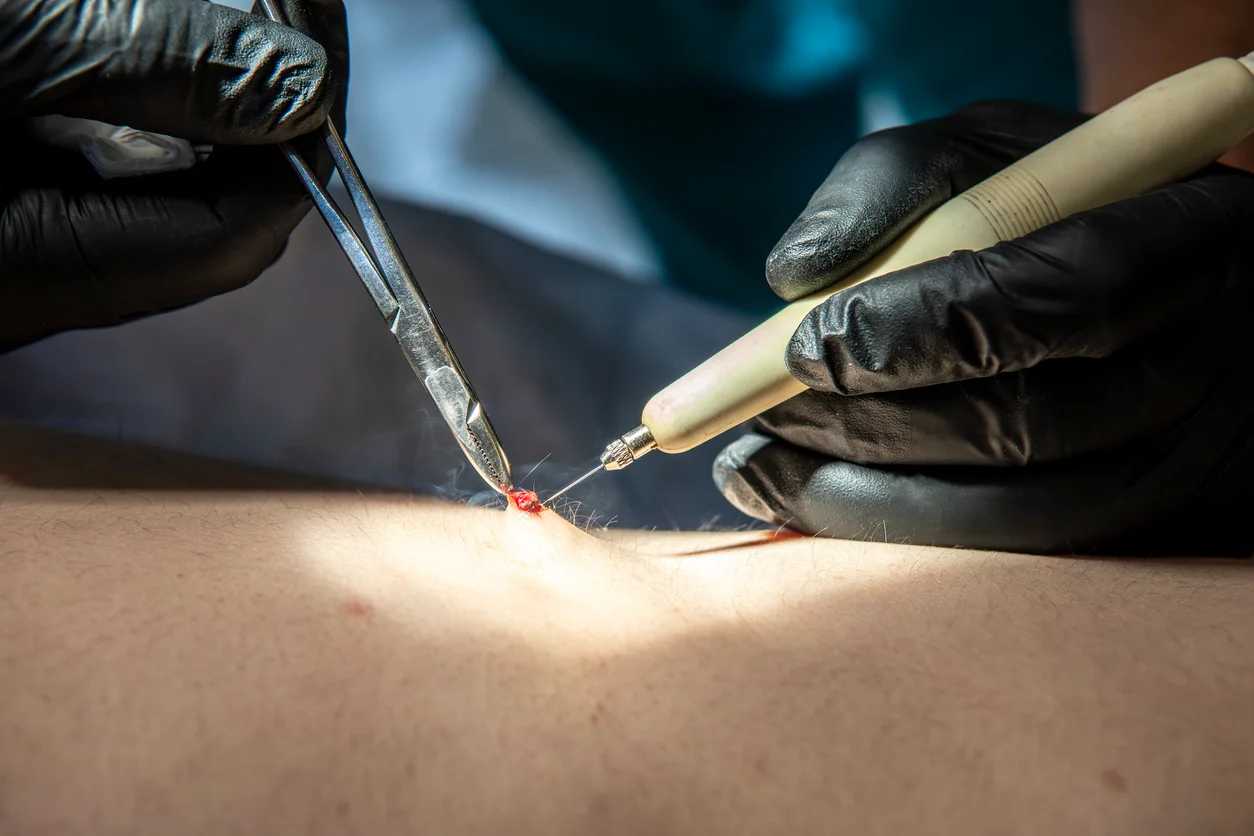iStock-2244242513 Surgical Management of Repeated Pilonidal Disease