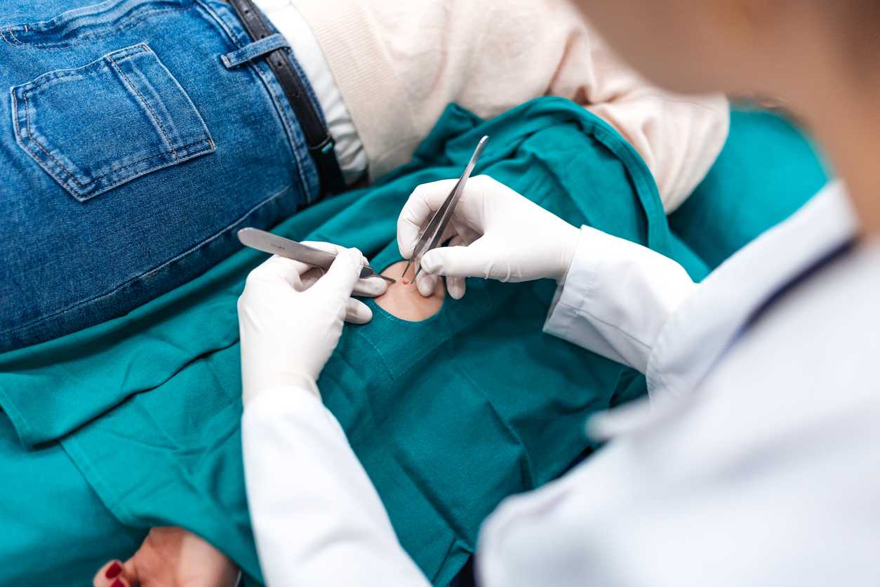 Pilonidal cyst medical treatment